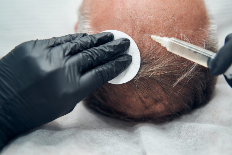 Cet homme paie un professionnel qualifié pour lui faire une greffe de cheveu