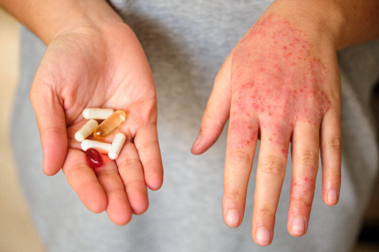 Une personne qui montre les pilules pour traiter l'eczéma