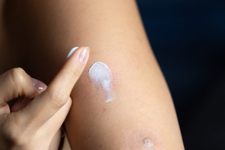 Une femme appliquant de la pommade pour traiter son psoriasis